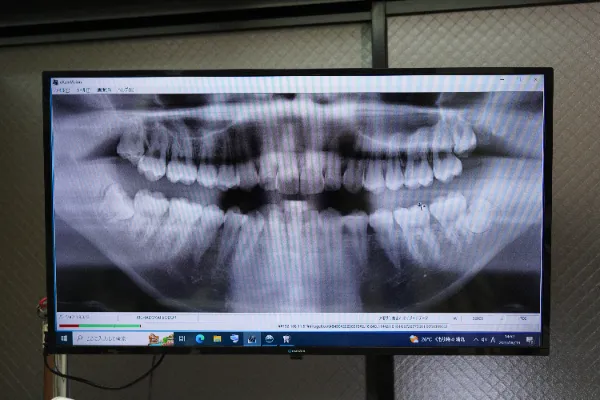 大宮駅の歯医者「アーバン歯科・矯正歯科 大宮ラクーン院」はレントゲン撮影を行って詳細な状態を把握します