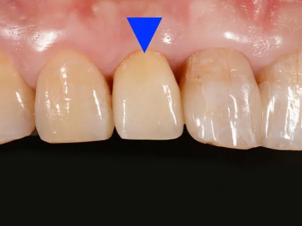 大宮駅の歯医者「アーバン歯科・矯正歯科 大宮ラクーン院」はメタルボンドを用いた治療を行っています