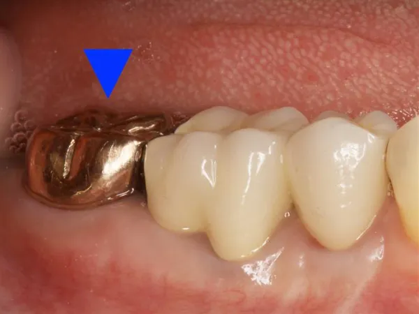 大宮駅の歯医者「アーバン歯科・矯正歯科 大宮ラクーン院」はゴールドクラウンを用いた治療を行っています