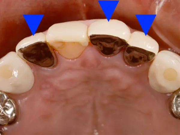 大宮駅の歯医者「アーバン歯科・矯正歯科 大宮ラクーン院」は硬質レジン前装冠を用いた治療を行っています