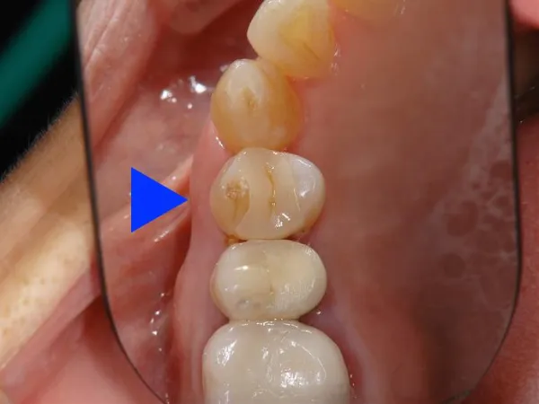 大宮駅の歯医者「アーバン歯科・矯正歯科 大宮ラクーン院」はセラミックインレーを用いた治療を行っています