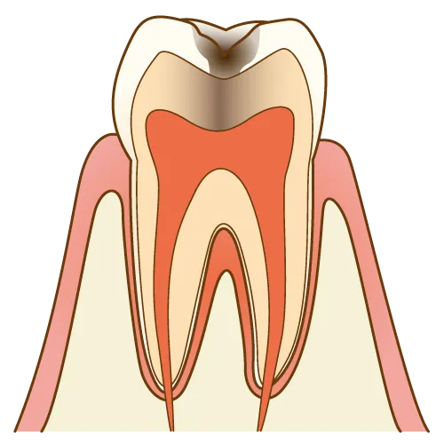 大宮駅の歯医者「アーバン歯科・矯正歯科 大宮ラクーン院」は虫歯の進行度による治療方法を工夫しています