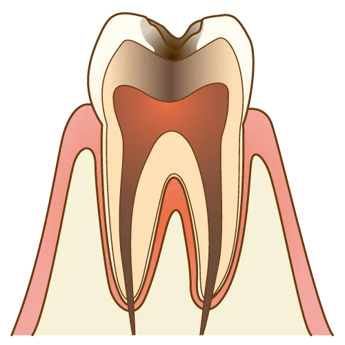 大宮駅の歯医者「アーバン歯科・矯正歯科 大宮ラクーン院」は虫歯の進行度による治療方法を工夫しています