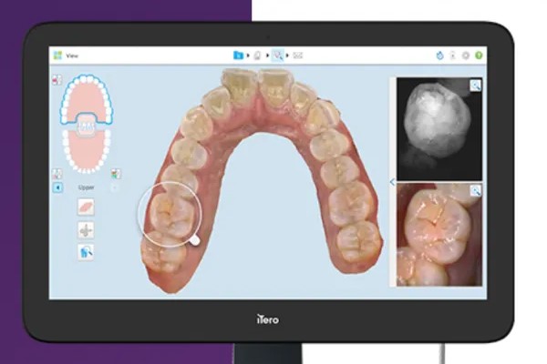 大宮駅の歯医者「アーバン歯科・矯正歯科 大宮ラクーン院」は口腔内デジタルスキャンを導入し、細かな診断