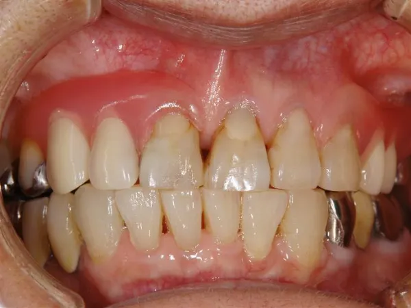 大宮駅の歯医者「アーバン歯科・矯正歯科 大宮ラクーン院」の入れ歯治療はノンクラスプデンチャーに対応しています