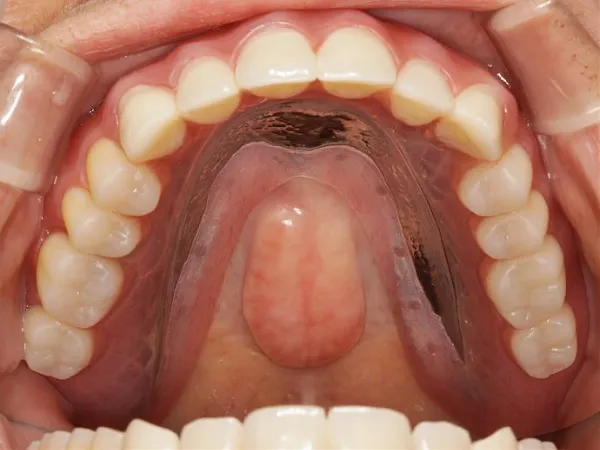大宮駅の歯医者「アーバン歯科・矯正歯科 大宮ラクーン院」の入れ歯治療は金属床義歯に対応しています