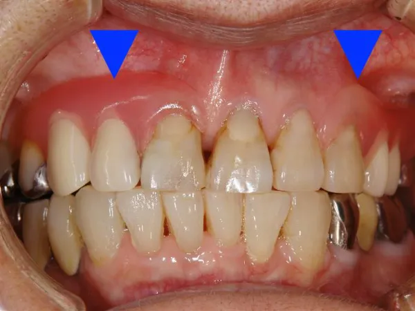 大宮駅の歯医者「アーバン歯科・矯正歯科 大宮ラクーン院」はノンスクラブを用いた治療を行っています