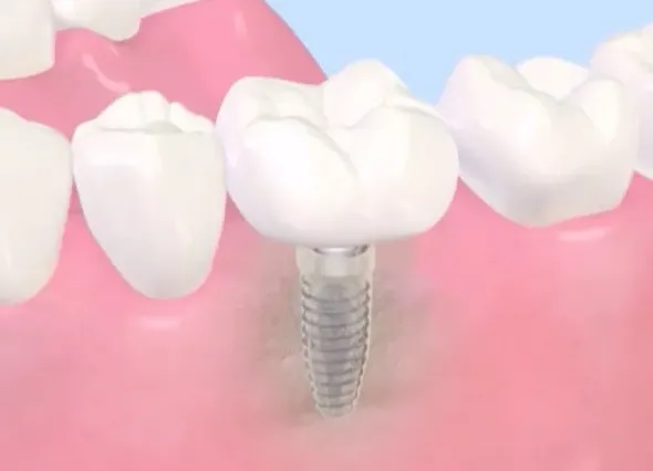 大宮駅の歯医者「アーバン歯科・矯正歯科 大宮ラクーン院」が歯を失った場合の治療方法をご紹介します