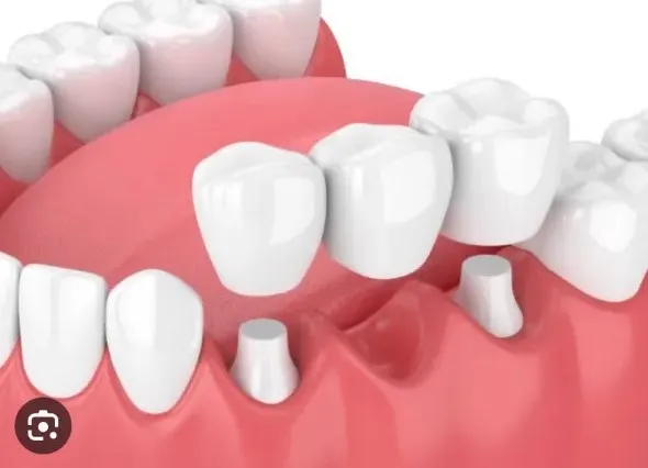 大宮駅の歯医者「アーバン歯科・矯正歯科 大宮ラクーン院」が歯を失った場合の治療方法をご紹介します