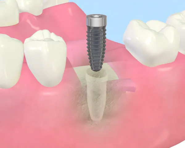 大宮駅の歯医者「アーバン歯科・矯正歯科 大宮ラクーン院」のインプラント治療は人工歯根を顎の骨に埋入します