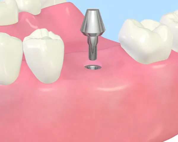 大宮駅の歯医者「アーバン歯科・矯正歯科 大宮ラクーン院」のインプラント治療はアバットメントを取り付けます