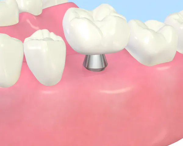 大宮駅の歯医者「アーバン歯科・矯正歯科 大宮ラクーン院」のインプラント治療は上部構造（人工歯）を作製します