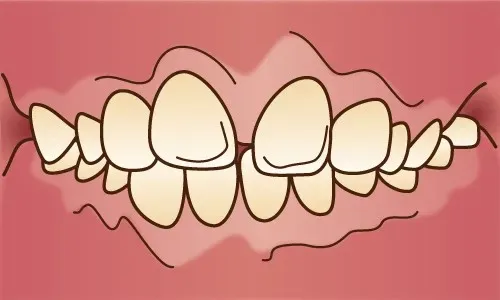 大宮駅の歯医者「アーバン歯科・矯正歯科 大宮ラクーン院」の矯正歯科は出っ歯（上顎前突）の症例に対応しています