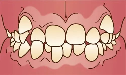大宮駅の歯医者「アーバン歯科・矯正歯科 大宮ラクーン院」の矯正歯科は乱ぐい歯・八重歯（叢生）の症例に対応しています