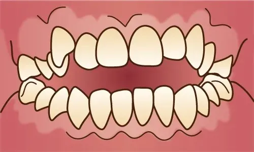 大宮駅の歯医者「アーバン歯科・矯正歯科 大宮ラクーン院」の矯正歯科は開咬の症例に対応しています