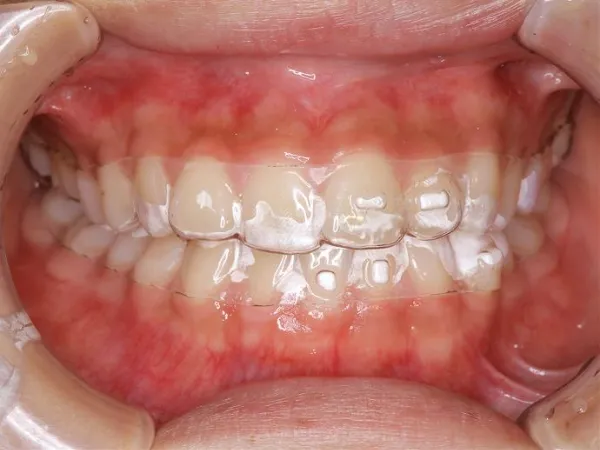 大宮駅の歯医者「アーバン歯科・矯正歯科 大宮ラクーン院」の矯正歯科はマウスピース矯正に対応しています