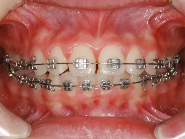 大宮駅の歯医者「アーバン歯科・矯正歯科 大宮ラクーン院」の矯正歯科はワイヤー矯正に対応しています