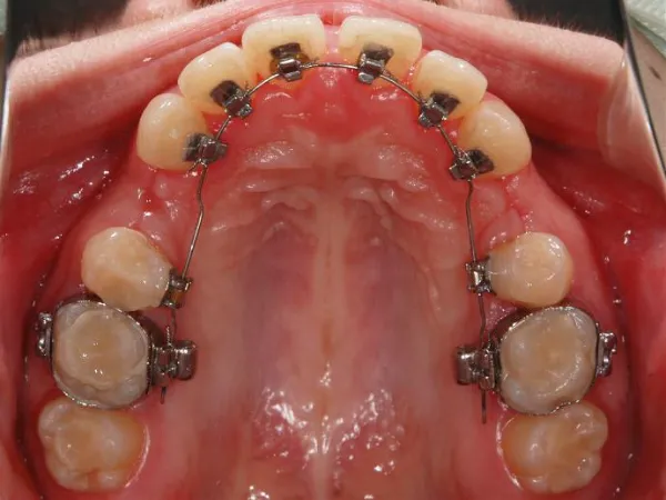 大宮駅の歯医者「アーバン歯科・矯正歯科 大宮ラクーン院」の矯正歯科は舌側矯正に対応しています