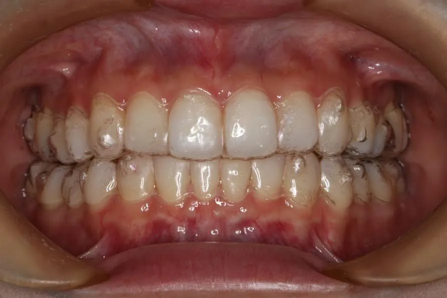 大宮駅の歯医者「アーバン歯科・矯正歯科 大宮ラクーン院」のインビザライン装着中の状態です
