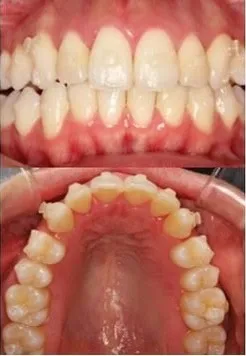 大宮駅の歯医者「アーバン歯科・矯正歯科 大宮ラクーン院」のインビザライン治療中の状態です