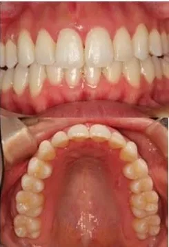 大宮駅の歯医者「アーバン歯科・矯正歯科 大宮ラクーン院」のインビザライン治療後の状態です