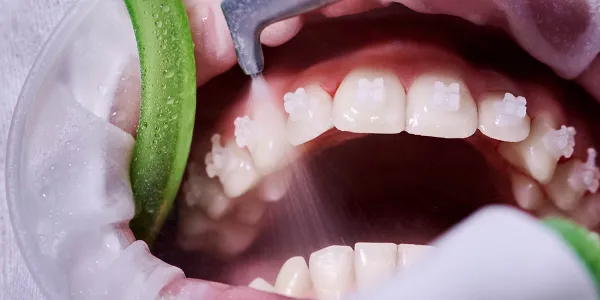 大宮駅の歯医者「アーバン歯科・矯正歯科 大宮ラクーン院」のエアフロ―は歯石や着色がつきにくくなります