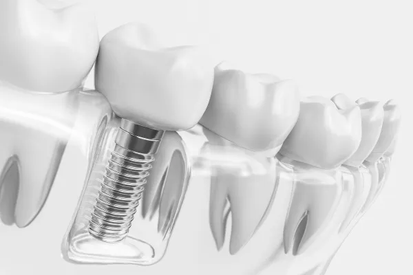 大宮駅の歯医者「アーバン歯科・矯正歯科 大宮ラクーン院」はインプラント治療で残っている歯を守ります