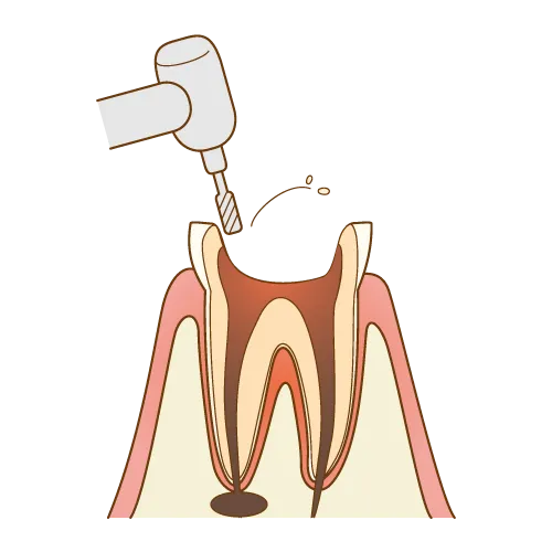 大宮駅の歯医者「アーバン歯科・矯正歯科 大宮ラクーン院」の根管治療は虫歯に冒された歯質を削り取ります