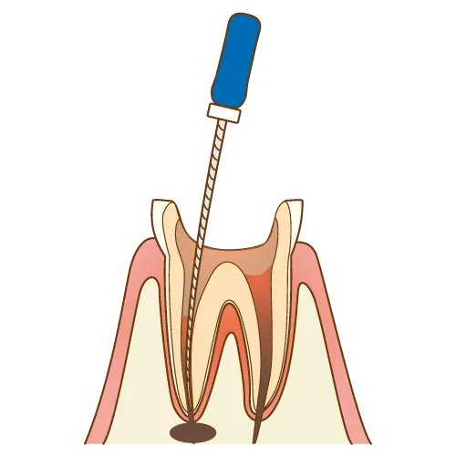大宮駅の歯医者「アーバン歯科・矯正歯科 大宮ラクーン院」の根管治療は神経が通っているスペースに穴を開けます
