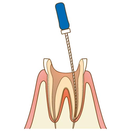 大宮駅の歯医者「アーバン歯科・矯正歯科 大宮ラクーン院」の根管治療は歯根の感染部分を除去します