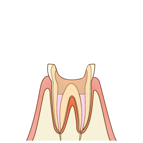 大宮駅の歯医者「アーバン歯科・矯正歯科 大宮ラクーン院」の根管治療は内部に薬を詰め、封鎖します