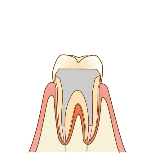 大宮駅の歯医者「アーバン歯科・矯正歯科 大宮ラクーン院」の根管治療は最後に詰め物もしくは被せ物で補います