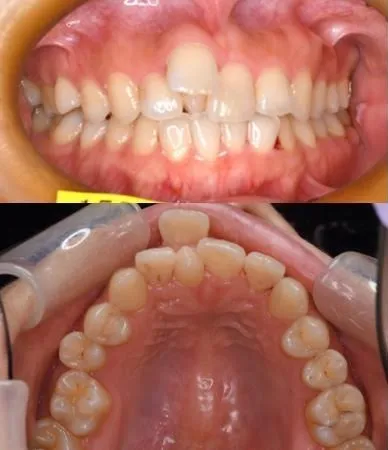 大宮駅の歯医者「アーバン歯科・矯正歯科 大宮ラクーン院」の裏側矯正治療前の状態です