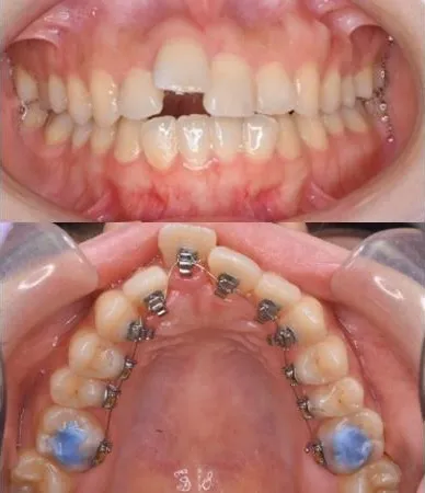 大宮駅の歯医者「アーバン歯科・矯正歯科 大宮ラクーン院」の裏側矯正治療中の状態です