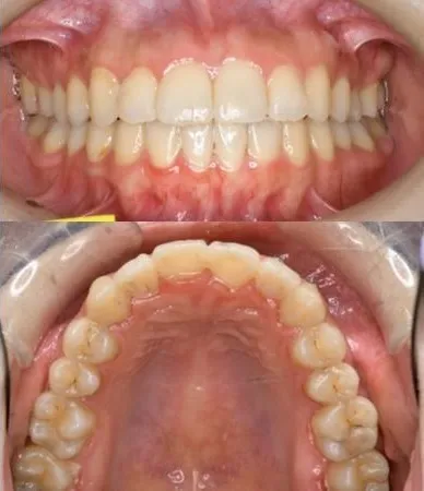 大宮駅の歯医者「アーバン歯科・矯正歯科 大宮ラクーン院」の裏側矯正治療後の状態です