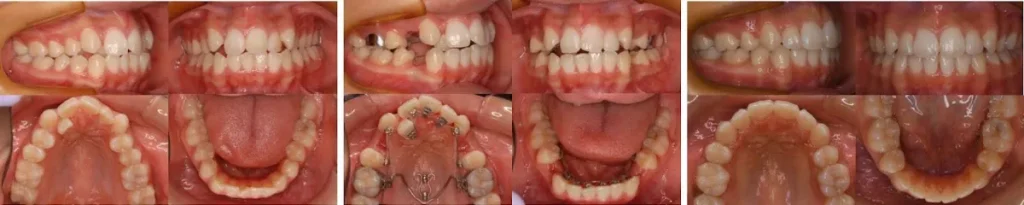 大宮駅の歯医者「アーバン歯科・矯正歯科 大宮ラクーン院」の裏側矯正治療前～治療後の状態です